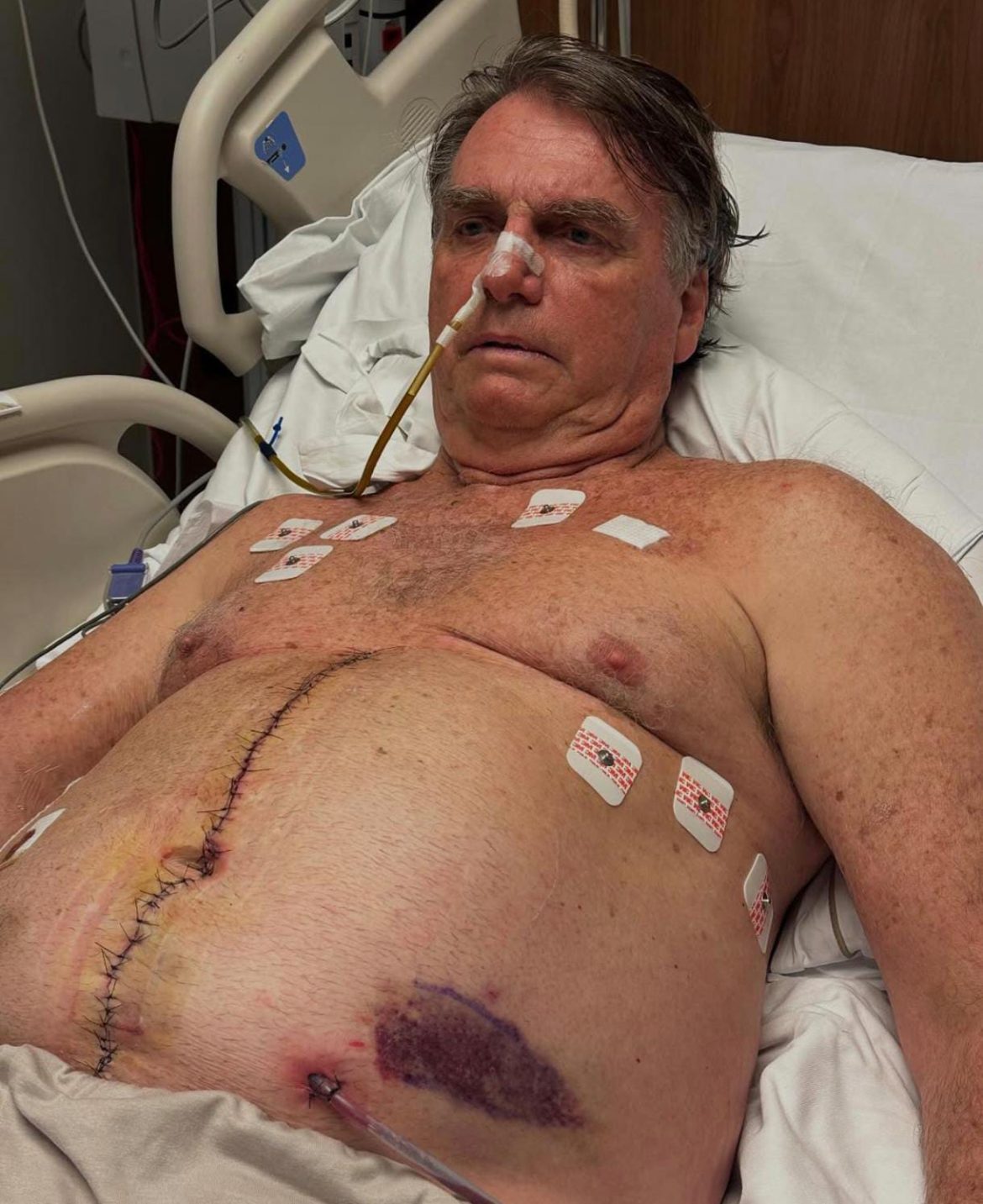 Internado na UTI, Jair Bolsonaro segue em recuperação após cirurgia no abdômen